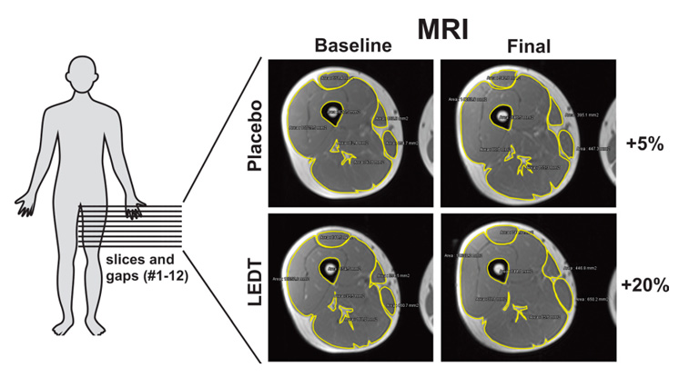 MR-scanning - muskelvolumen